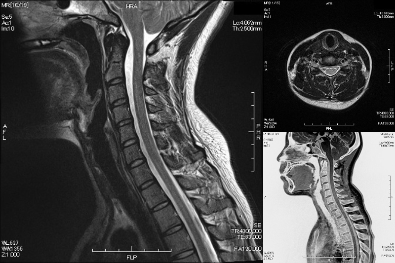 頚椎MRIでは頚部脊髄における頚椎症、頚椎椎間板ヘルニア、頚椎脊柱管狭窄症、後縦靭帯骨化症など、さまざまな頚椎疾患に有用です。頭痛や、腕～指先のしびれ、肩こりなどの原因検索を行なう撮像です。また、当院MRIではBone Image(CT like Image)法を使用し、OPLLや椎間孔内の小さな病変も観察可能です。