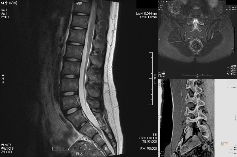 腰椎MRIは椎体、椎間疾患に限らず、広範囲の脂肪抑制画像を駆使し、股関節病変や骨盤、仙腸関節に原因疾患がないか撮像します。また、分離・すべり症ではBone Imageを併用し、CTと同様に骨折部の評価ができます。X線被ばくがないので分離症の治療経過観察に特に有用です。