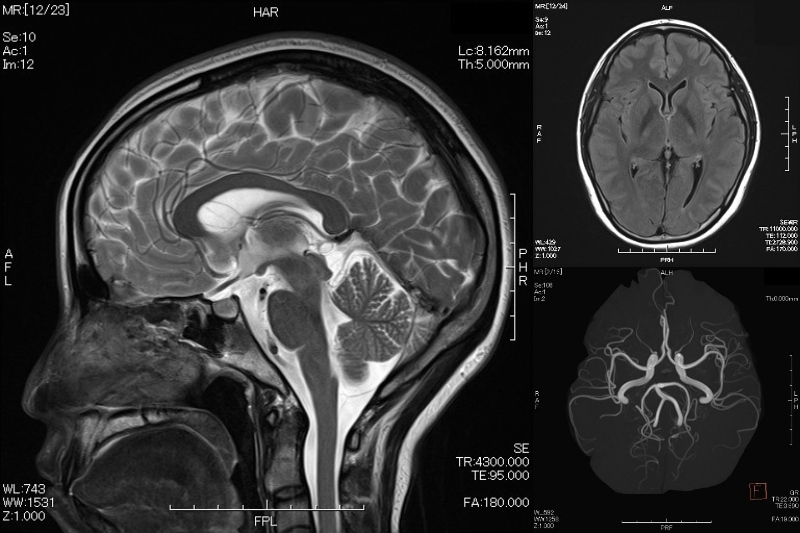 脳MRIドックの特徴、費用、オススメのオプション検査をご紹介