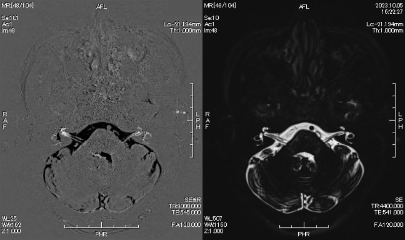 メニエール病の原因疾患の一つである内リンパ水腫を画像化するHYDROPSという撮像法です。他の検査所見を満たし、造影MRIで蝸牛と前庭の内リンパ水腫が確認されれば確定診断が出来ます。