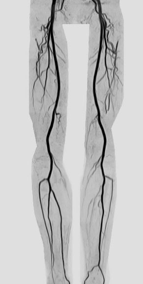 非造影の下肢MRA、写真例