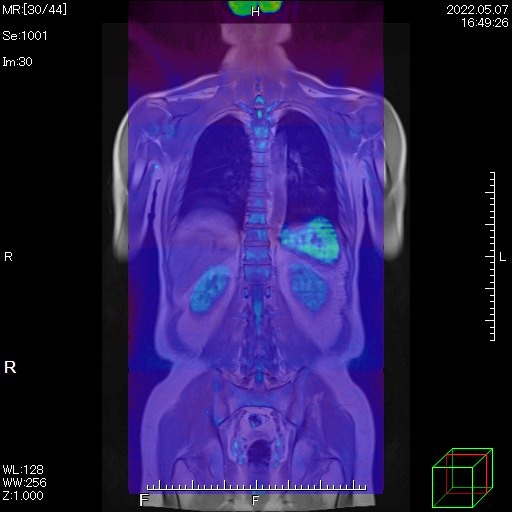 DWIBS(ドウィブス)、MRIで全身がん検査。仕組み、PETとの比較、予約方法