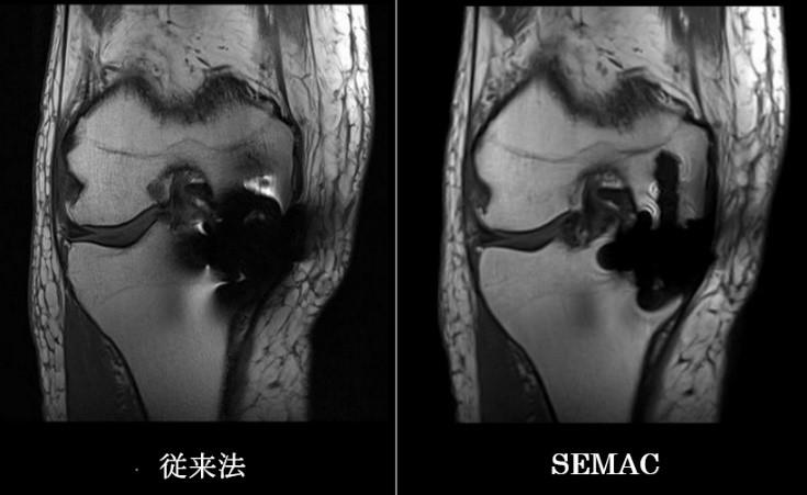 MRIにおいて体内インプラントは画質劣化の大きな要因となります。当院のMRI装置は、金属アーチファクトを低減するSEMAC（slice encoding for metal artifact correction）を搭載することでインプラントは無信号で描出されますが、従来法のように金属アーチファクトで診断できないという状況が改善できます。 